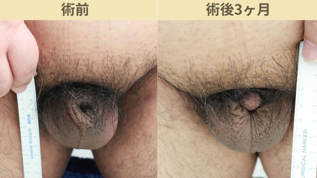 【症例30】30代男性 ｜アルモ式バック筋膜切開（靭帯剥離併用あり）＋包茎術で埋没陰茎改善へ術後3ヶ月