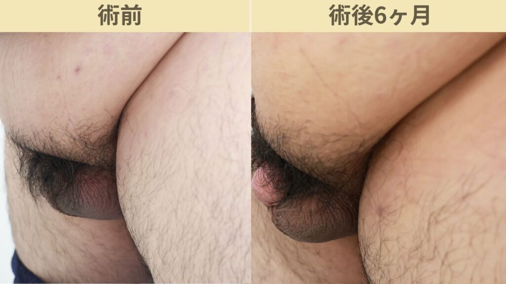 【症例30】30代男性 ｜アルモ式バック筋膜切開（靭帯剥離併用あり）＋包茎術で埋没陰茎改善へ術後6ヶ月2
