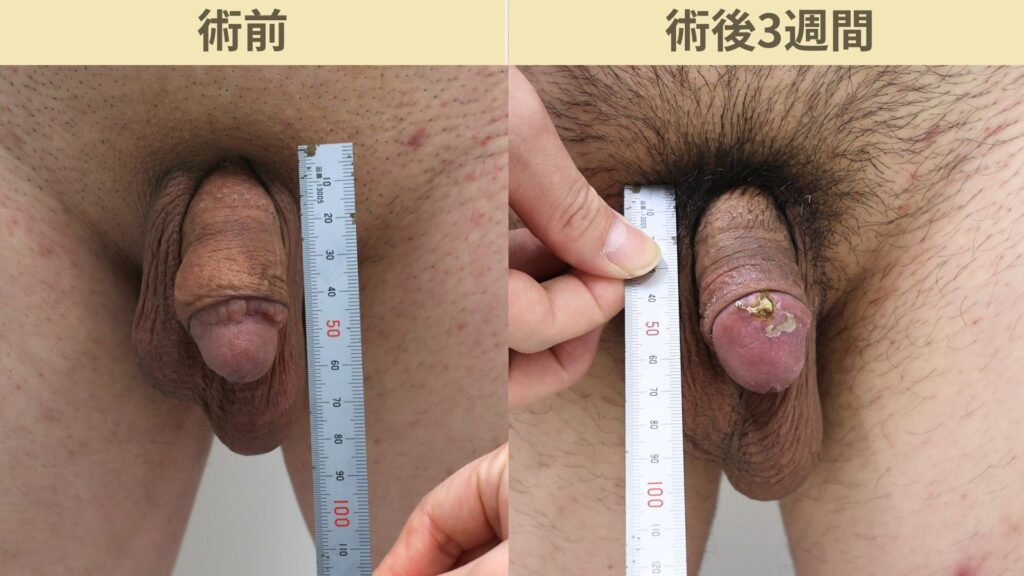 【症例88】40代男性 ｜真皮脂肪移植でふっくら自然な亀頭へ。陰茎増大術との併用例術後3週間