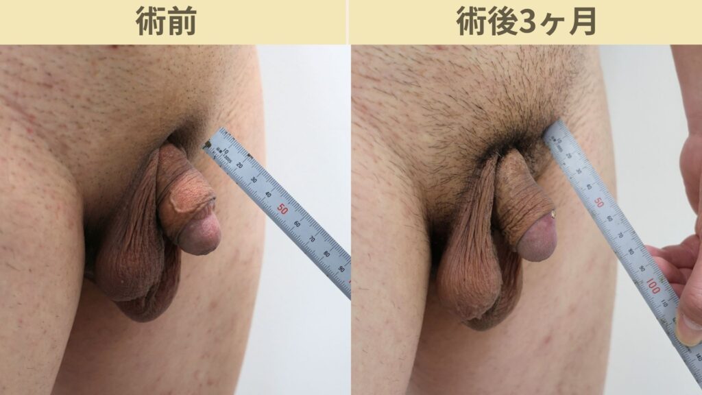 【症例87】40代男性 ｜アルモ式バック筋膜切開（靭帯剥離併用あり）＋真皮脂肪移植も併用術後3ヶ月3
