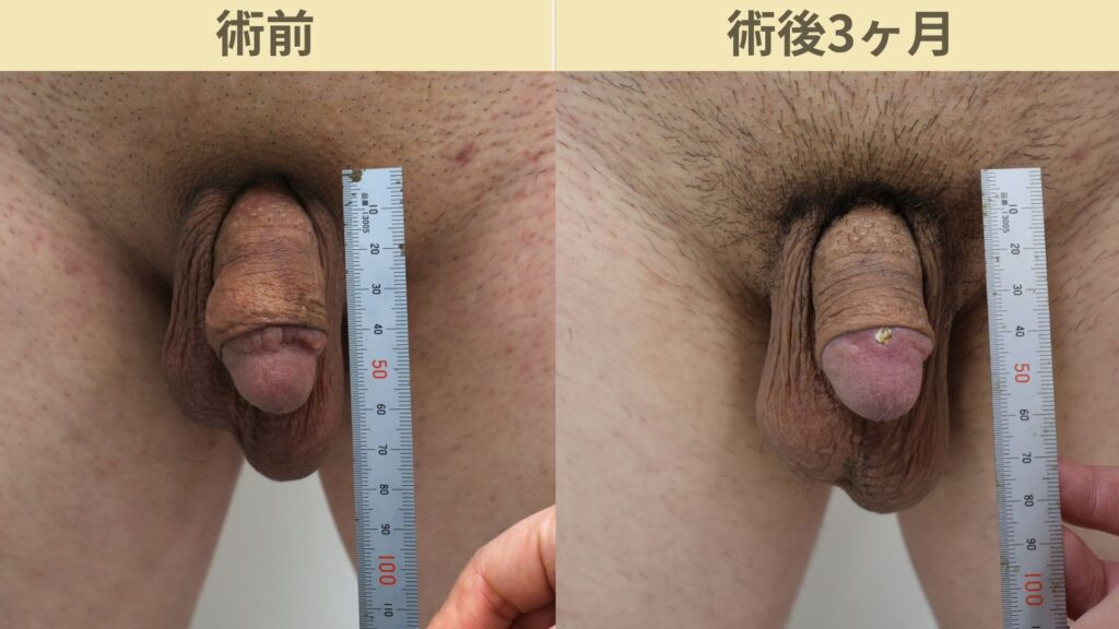 【症例88】40代男性 ｜真皮脂肪移植でふっくら自然な亀頭へ。陰茎増大術との併用例術後3ヶ月2