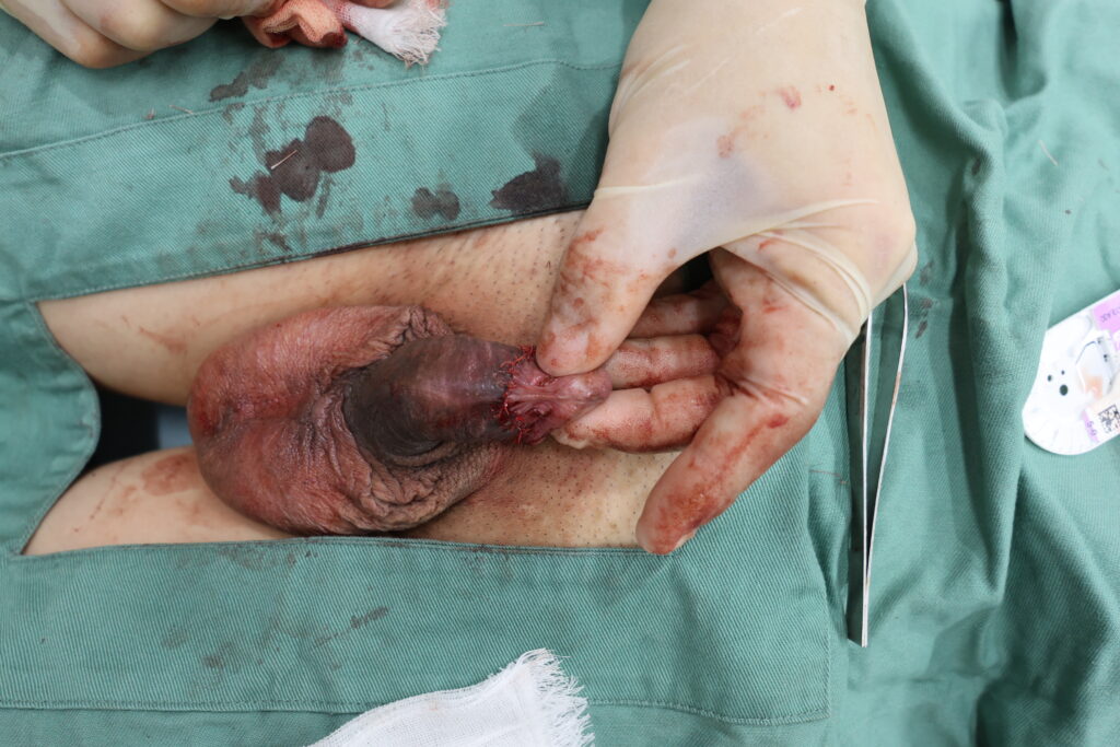 【症例89】50代男性 |アルモ式バック筋膜切開(靭帯剥離併用あり)と亀頭ブツブツ除去も併用術後3