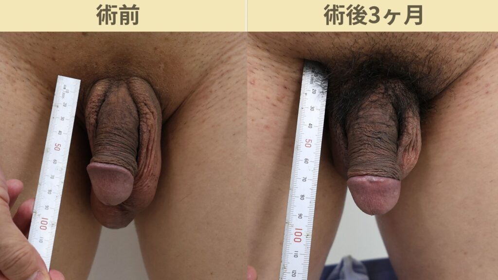 【症例90】50代男性 ｜真皮脂肪移植による亀頭増大で自然なカリ高を再現術後3ヶ月