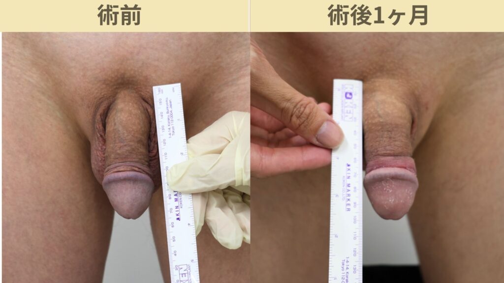 【症例66】陰茎増大術で13mm増大｜術後経過や患者様の本音を動画で公開術後1ヶ月3