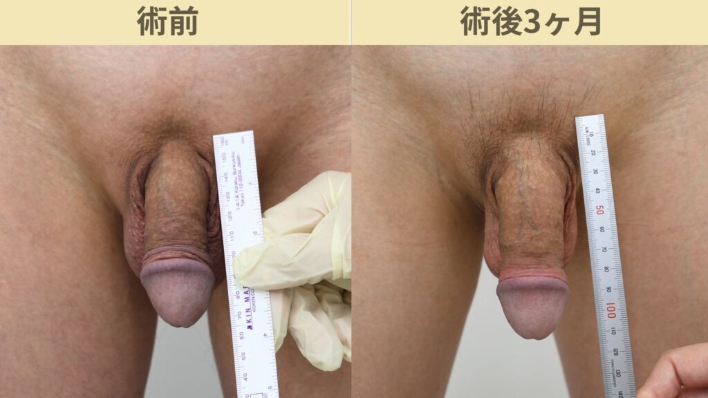 【症例66】陰茎増大術で13mm増大｜術後経過や患者様の本音を動画で公開術後3ヶ月3