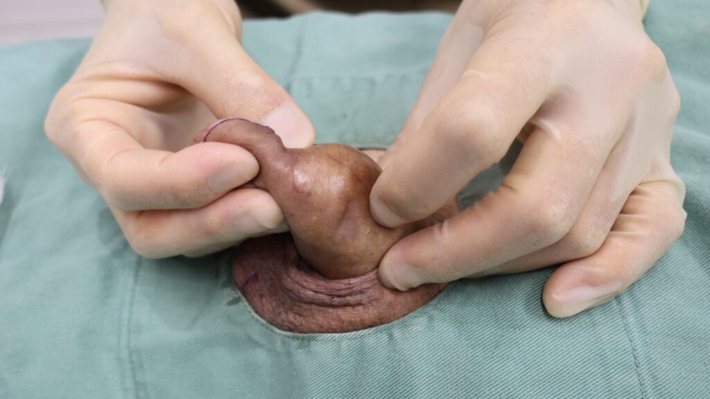 【症例91】60代男性 ｜アクアミド除去と同時に陰茎の太さを改善術前4