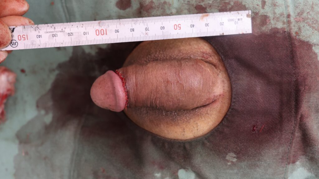 【症例91】60代男性 ｜アクアミド除去と同時に陰茎の太さを改善術後2