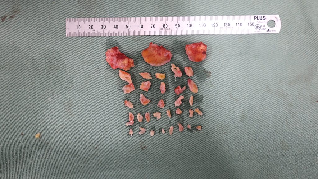 リパス除去+他院修正術後